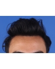 After Hair Transplant&nbsp;Front